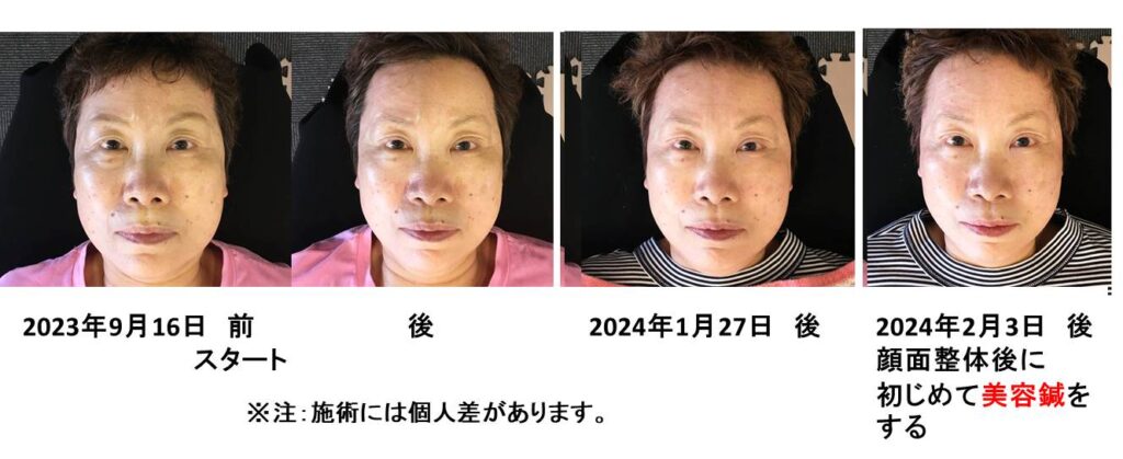 顔面整体のスタート時から、初めて美容鍼を受けた回までの顔写真の比較